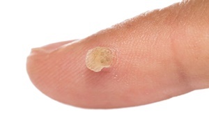 Kutil adalah penyakit kulit yang efektif melawan memperbaiki seluruh bagian Pro
